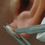 exame hanseniase pesquisa - coleta do material