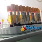 Exame de bilirrubina direta, total e indireta no sangue