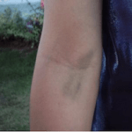 hematoma coleta sangue