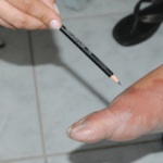 hanseniase teste para avaliar