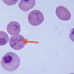 reticulócitos exame