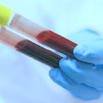 exame HBeAg como colher o sangue