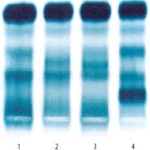 eletroforese de hemoglobina exame de sangue