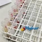 tsh exame de sangue hipo e hipertireoidismo