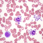 PDW exame resultado plaquetas