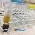 Exame Paracoccidioidomicose ou blastomicose