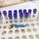 exame de sangue HLA B27 espondilite