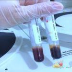 laboratório exame de sangue sarampo IgG e IgM