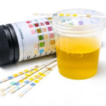 resultado de exame de urina com corpos cetônicos ou cetonas