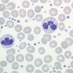 plaquetas aumentadada leucocitose