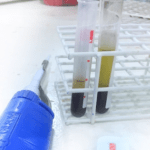 exame de sangue CA 72 4 coleta e resultado