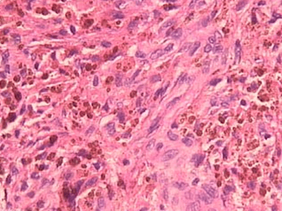 pigmentos por hemossiderina exame