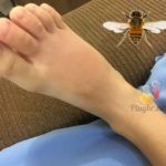 Picada de abelha no pé do filho