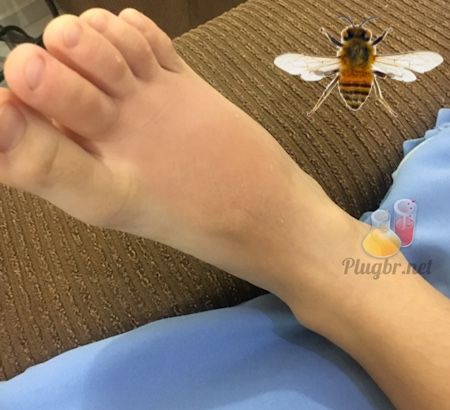 Picada de abelha no pé do filho