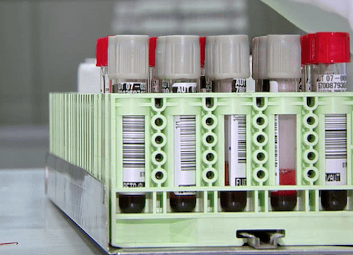 Exame de sangue brucelose